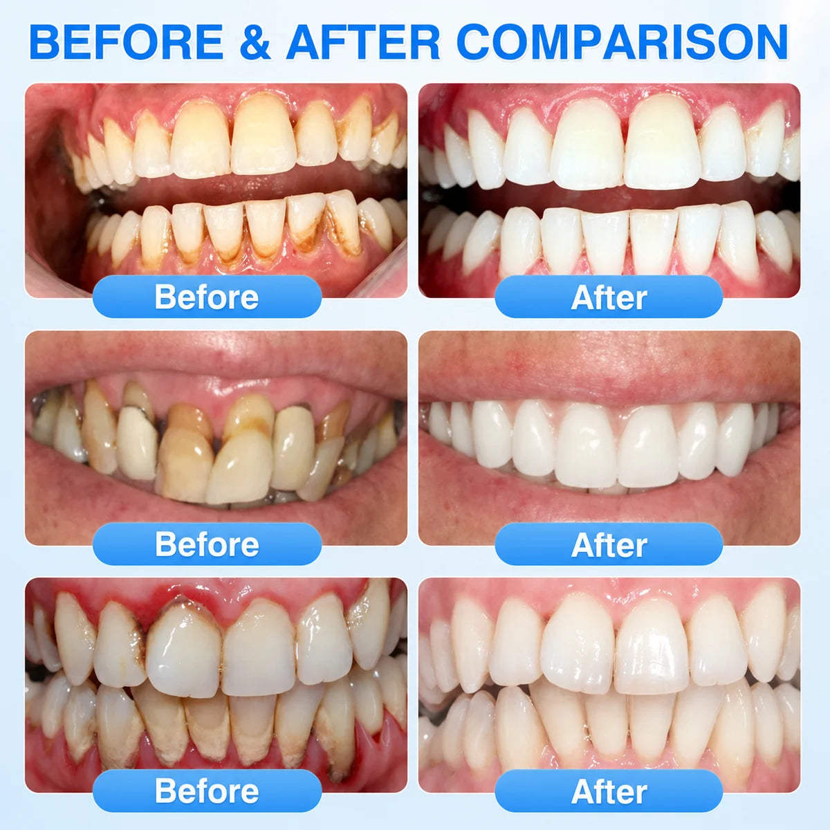 Teeth Repair Gel Whitening Pen — The Same Active Dentists Use, Without the Chair