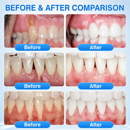 Teeth Repair Gel Whitening Pen — The Same Active Dentists Use, Without the Chair