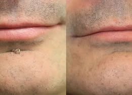 ✨Hydranya®2-in-1 Microneedle & Hydrocolloid Patch🍀| Removes Raised Moles, Acne, Flat Warts & Skin Tags | Helps Improve Wrinkles, Scars & Blemishes | Invisible Patches for Face & Body