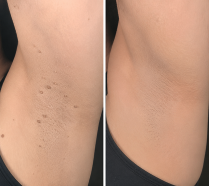 ✨Hydranya®2-in-1 Microneedle & Hydrocolloid Patch🍀| Removes Raised Moles, Acne, Flat Warts & Skin Tags | Helps Improve Wrinkles, Scars & Blemishes | Invisible Patches for Face & Body