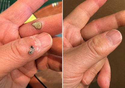 ✨Hydranya®2-in-1 Microneedle & Hydrocolloid Patch🍀| Removes Raised Moles, Acne, Flat Warts & Skin Tags | Helps Improve Wrinkles, Scars & Blemishes | Invisible Patches for Face & Body
